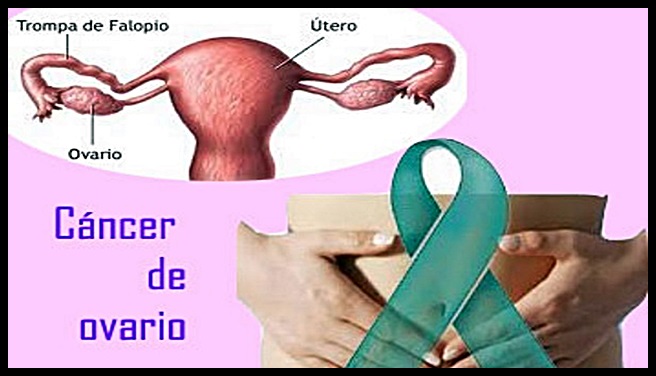 cancer de ovario